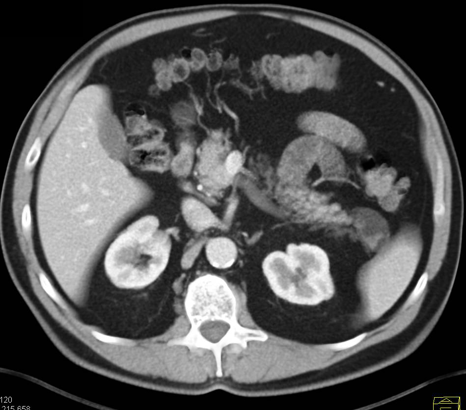 Lymphoepithelial Cyst of the Tail of the Pancreas - CTisus CT Scan