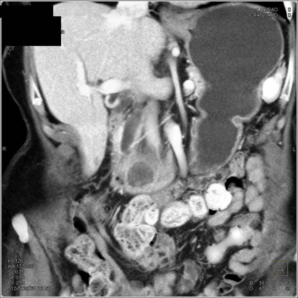 Intraductal Papillary Mucinous Neoplasm (IPMN) of the Pancreas - CTisus CT Scan