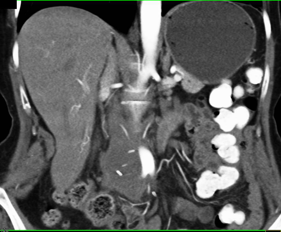 Recurrent Pancreatic Cancer - CTisus CT Scan