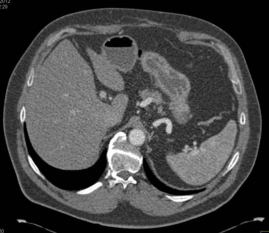 Vascular Metastases to Head of Pancreas from Renal Cell Carcinoma - CTisus CT Scan