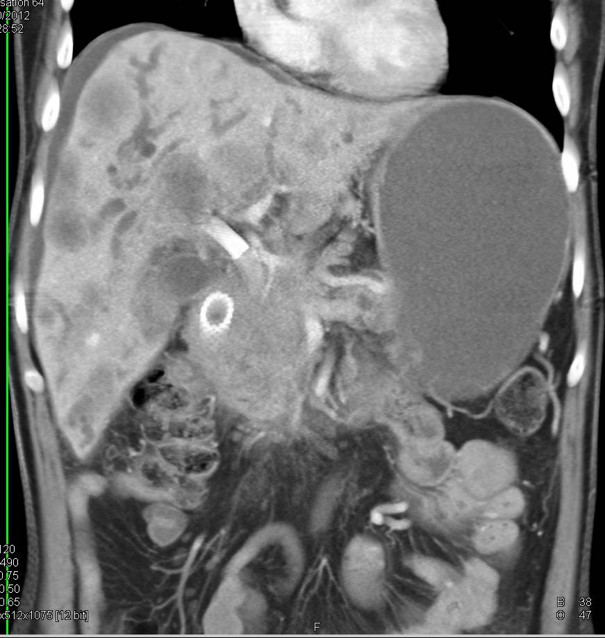 Pancreatic Cancer with Liver Metastases - CTisus CT Scan