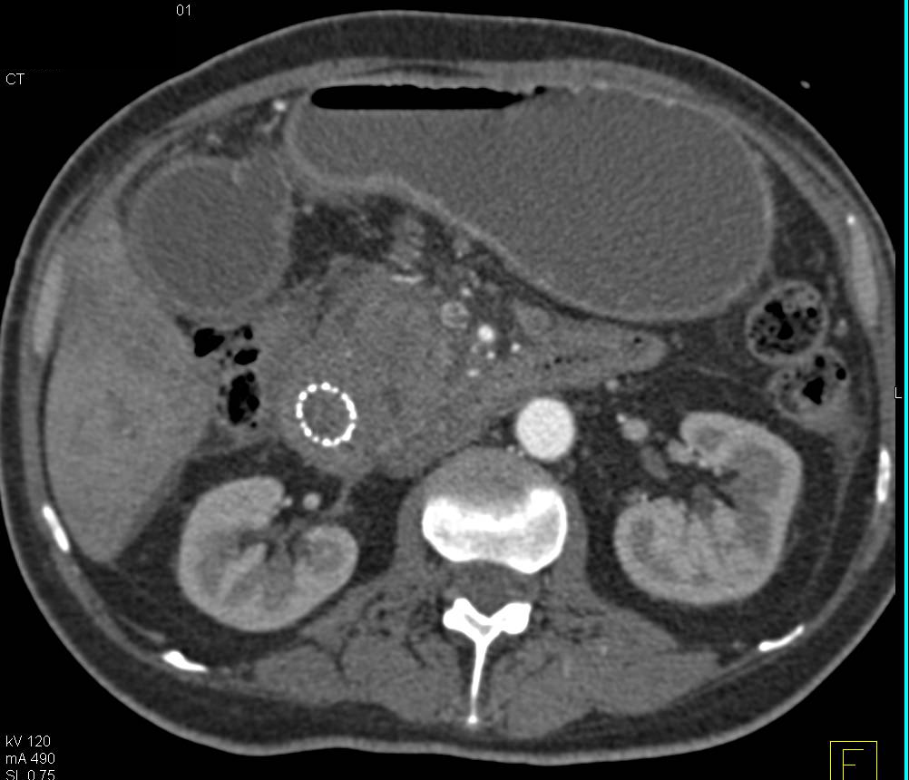 Pancreatic Cancer Causes Gastric Outlet Obstruction - CTisus CT Scan