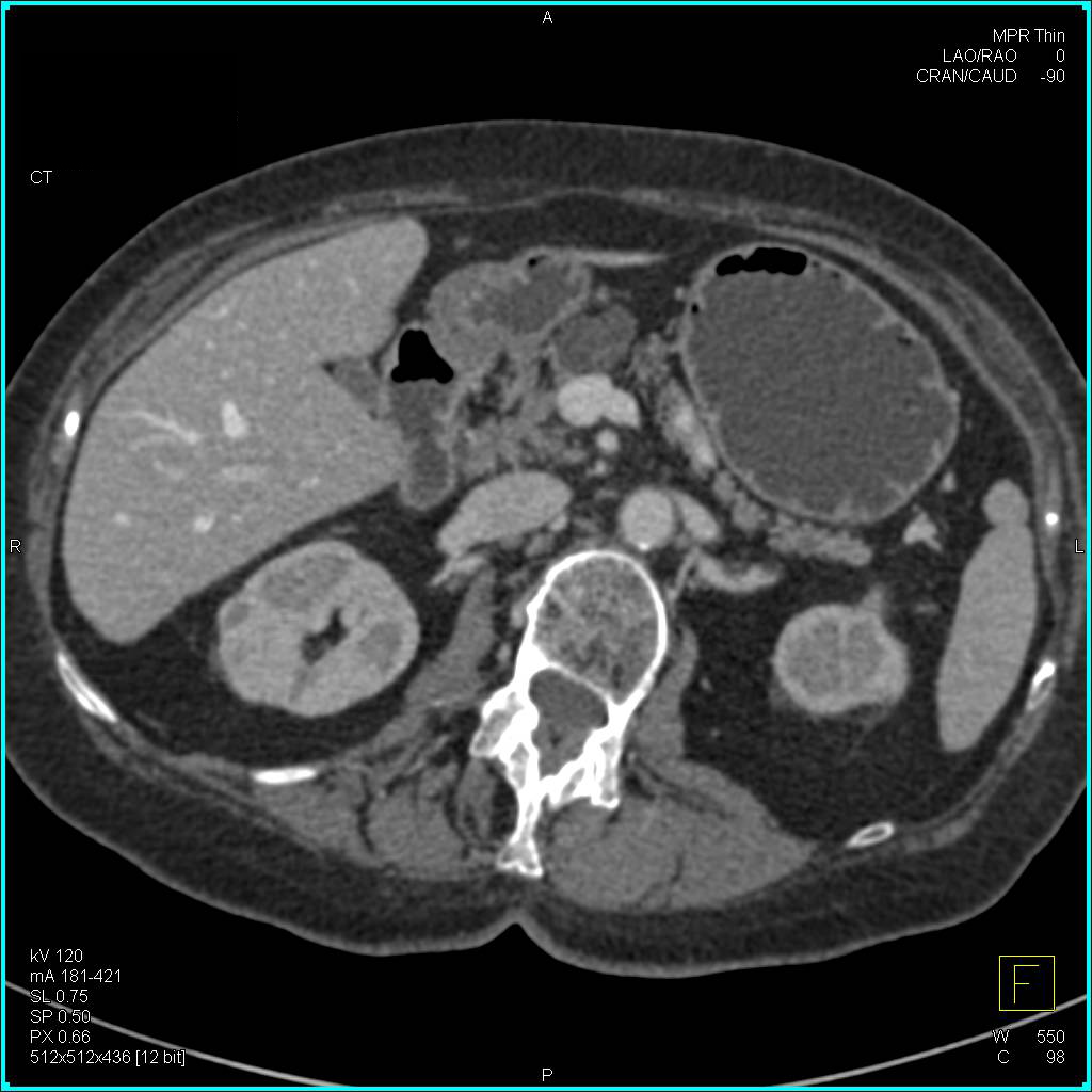 Multiple Pancreatic Intraductal Papillary Mucinous Neoplasms (IPMNs) - CTisus CT Scan