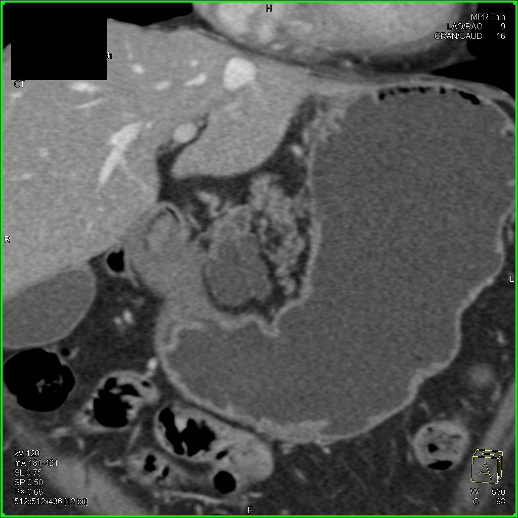 Lymphoepithelial Cyst of the Pancreas - CTisus CT Scan