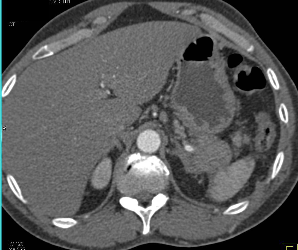 Carcinoma in the Tail of the Pancreas - CTisus CT Scan