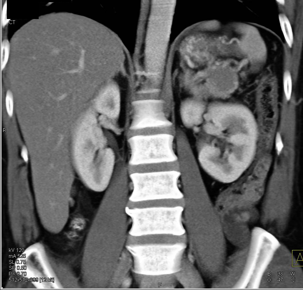 Carcinoma Tail of Pancreas with Aneurysm Splenic Artery - CTisus CT Scan