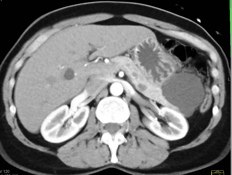 Lymphoepithelial Cyst of the Tail of the Pancreas - CTisus CT Scan