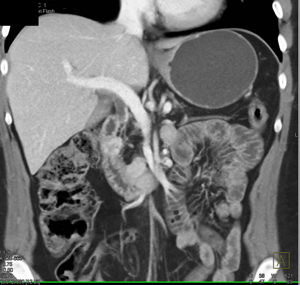 Neuroendocrine Tumor Near Head of Pancreas and Nodes Duodenum 2nd Portion - CTisus CT Scan