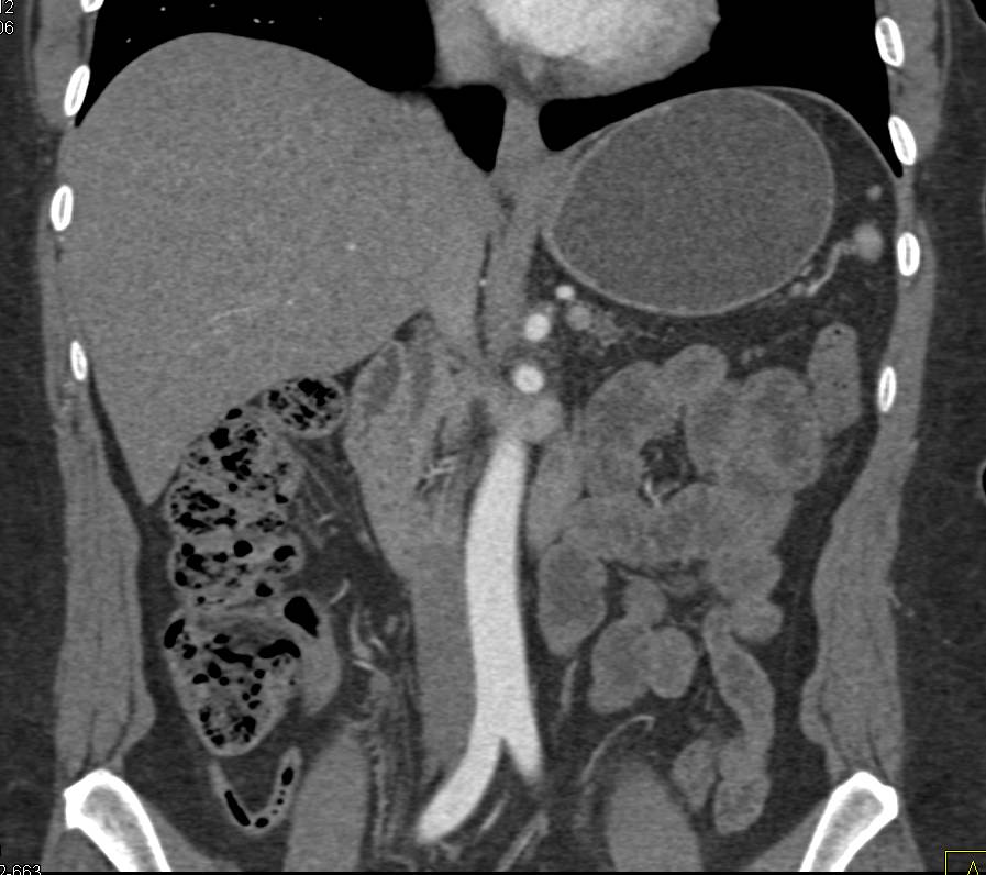 Neuroendocrine Tumor Near Head of Pancreas - CTisus CT Scan