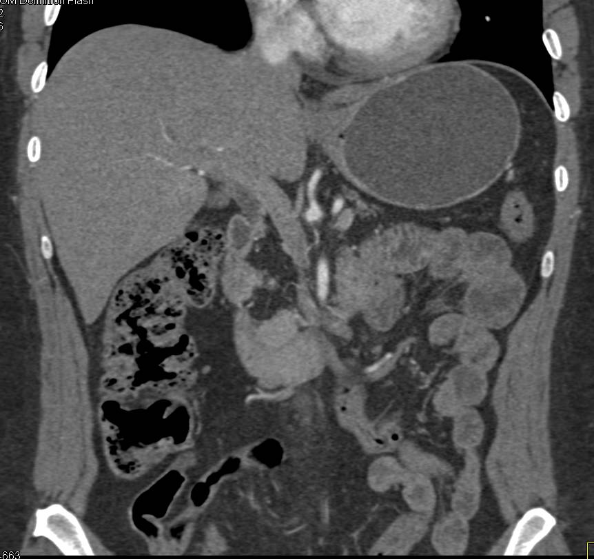 Neuroendocrine Tumor Near Head of Pancreas - Pancreas Case ...