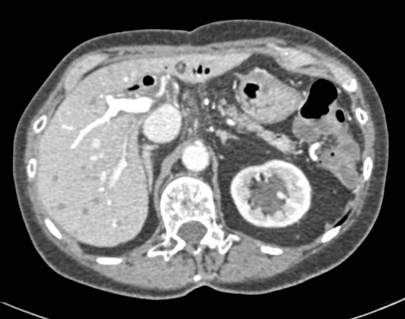 Liver Metastases s/p Whipple Procedure - CTisus CT Scan