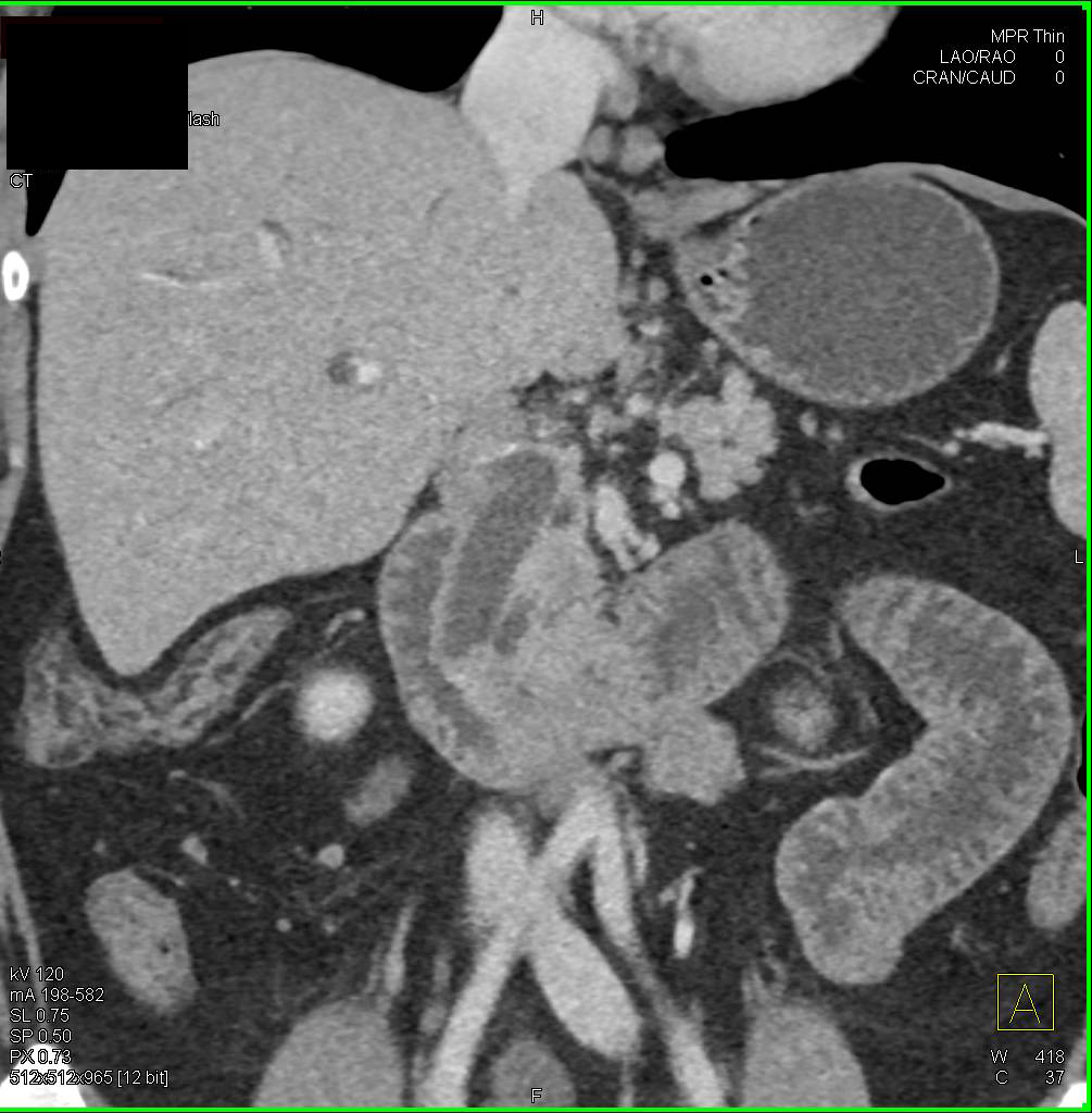 Carcinoid Tumor of Ampulla with Enhancing Peripancreatic Nodes - CTisus CT Scan