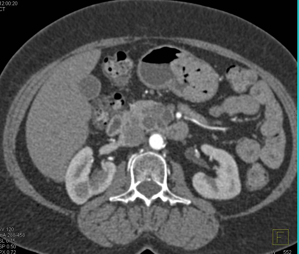 Serous Cystadenoma in Head of Pancreas - CTisus CT Scan