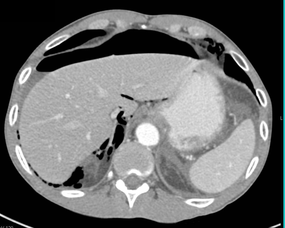 Post Endoscopic Retrograde Cholangiopancreatography (ERCP) with Perforation and Pneumoperitoneum - CTisus CT Scan