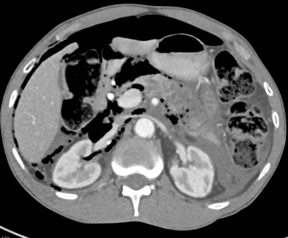 Perforation from Endoscopic Retrograde Cholangiopancreatography (ERCP) with Pneumoperitoneum - CTisus CT Scan