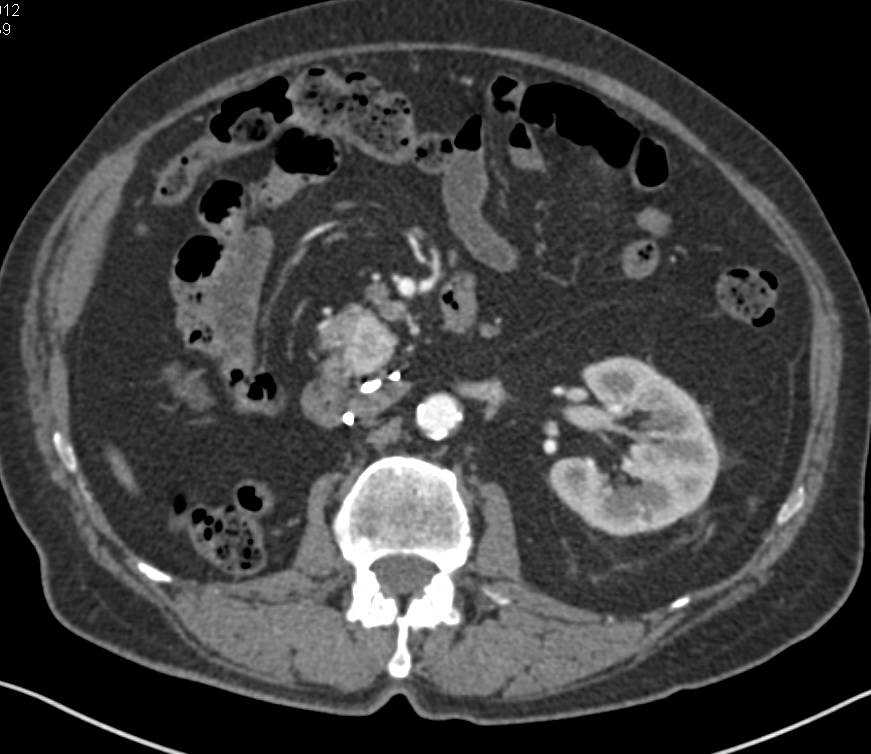 Metastases to the Pancreas from a Renal Cell Primary - CTisus CT Scan