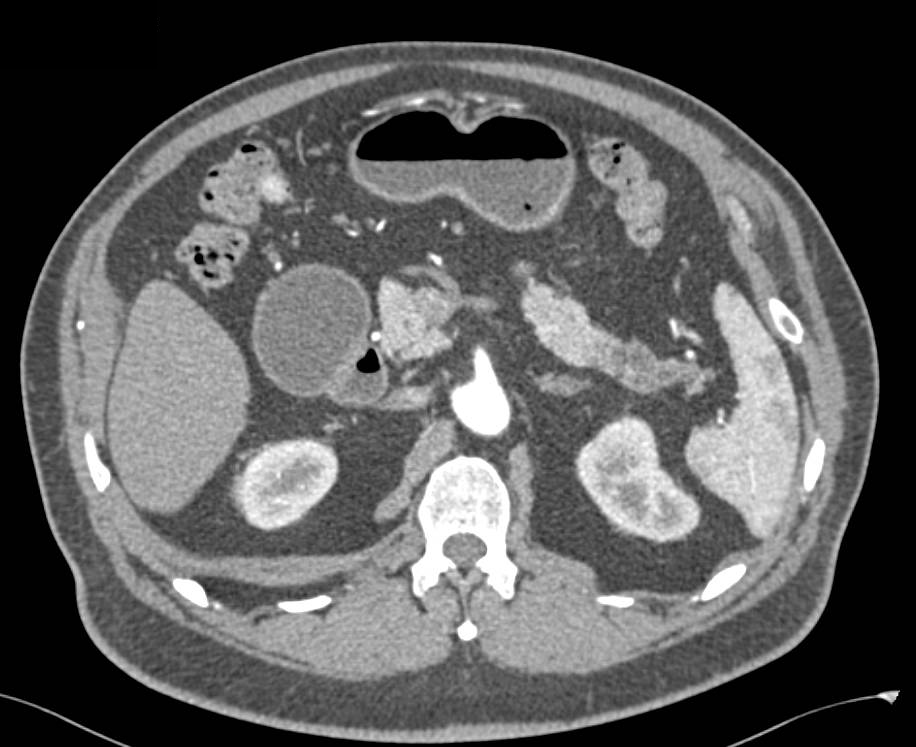 Subtle Pancreatic Cancer with Focal Duct Cutoff Tail of Pancreas - CTisus CT Scan