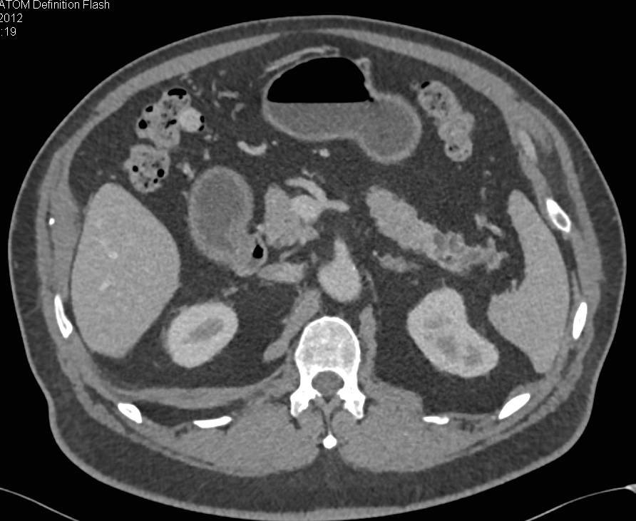 Dilated Pancreatic Duct in Tail of the Pancreas - CTisus CT Scan