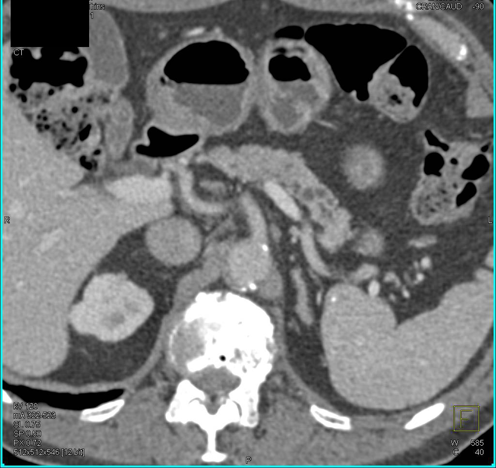 Multifocal Intraductal Papillary Mucinous Neoplasms (IPMNs) - CTisus CT Scan