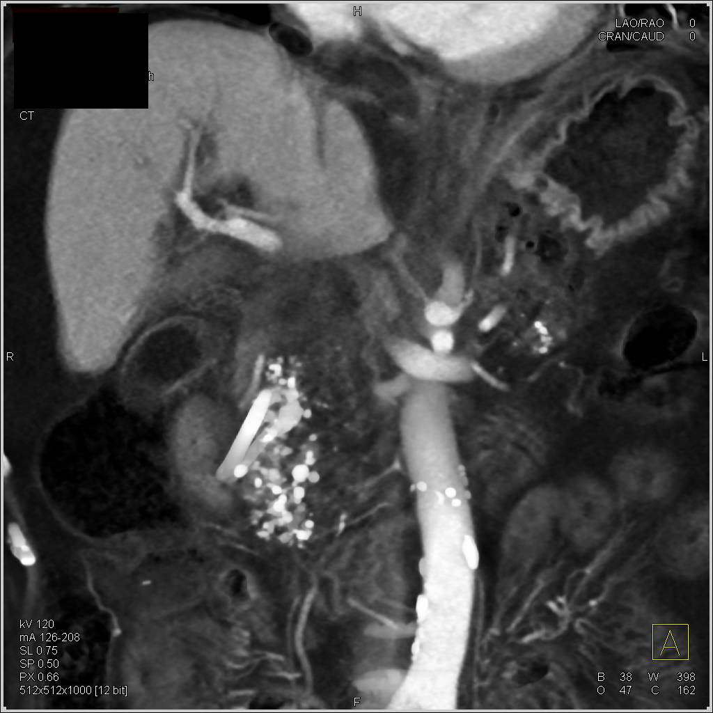 Infiltrating Pancreatic Cancer - CTisus CT Scan