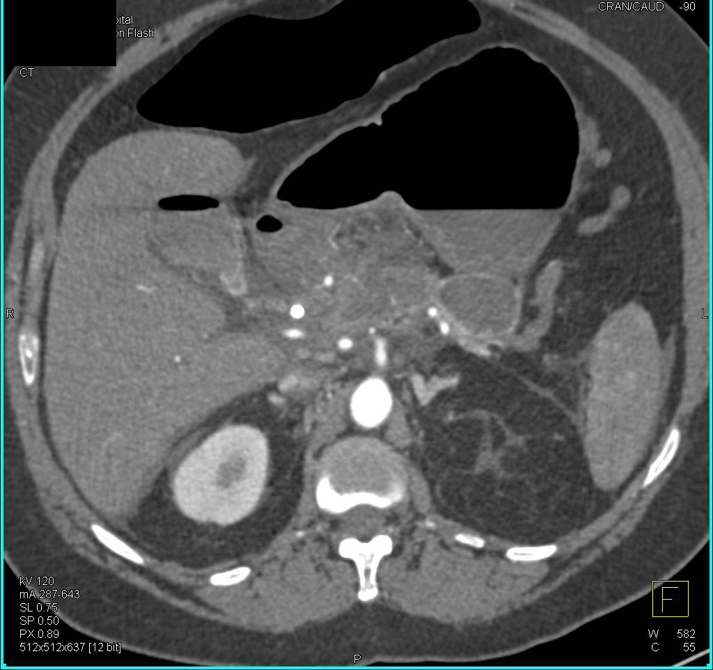 Pancreatic Adenocarcinoma Encases the Arterial and Venous Structures - CTisus CT Scan