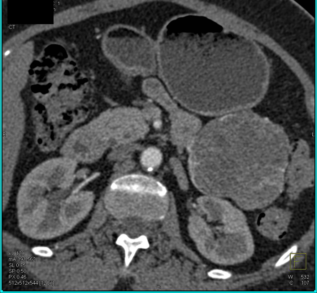 SPEN- Solitary Papillary Epithelial Neoplasm in Tail of Pancreas - CTisus CT Scan