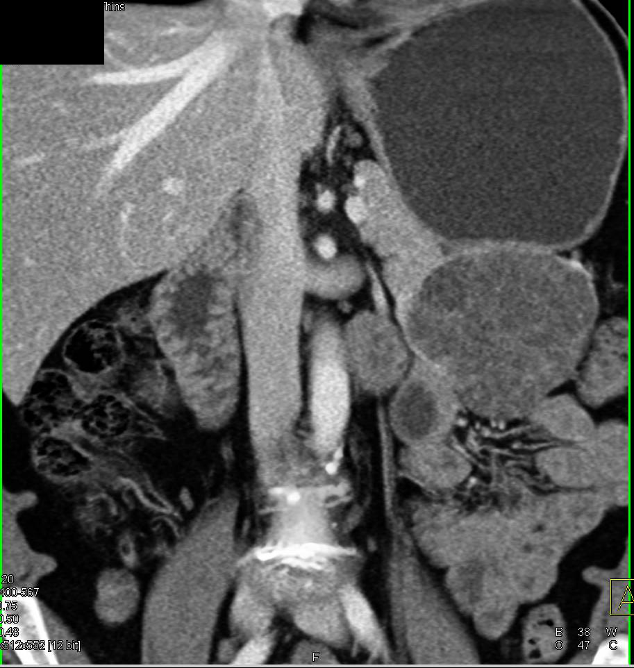 SPEN- Solitary Papillary Epithelial Neoplasm in Tail of Pancreas - CTisus CT Scan