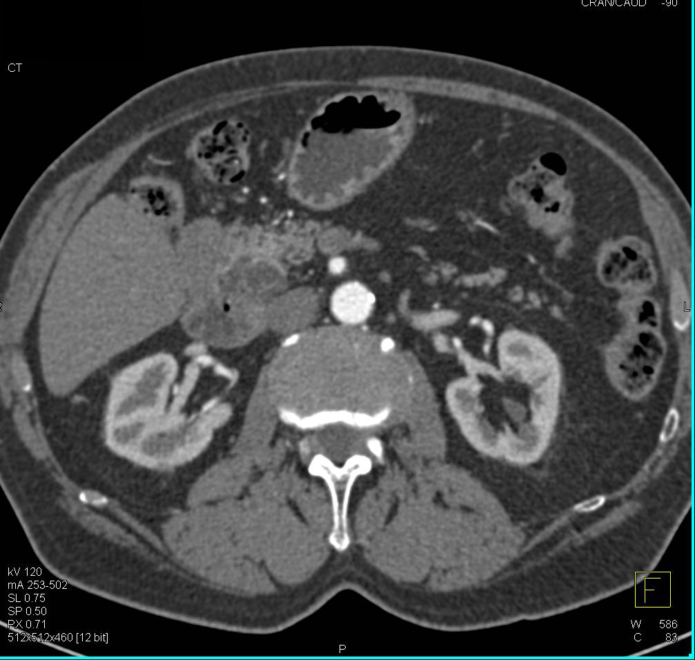 Intraductal Papillary Mucinous Neoplasm (IPMN) in Head of Pancreas - CTisus CT Scan