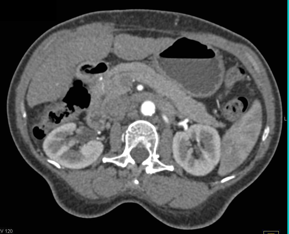 Arterial Phase Images Suggest Pancreas Tail Mass Which was Actually Varices - CTisus CT Scan