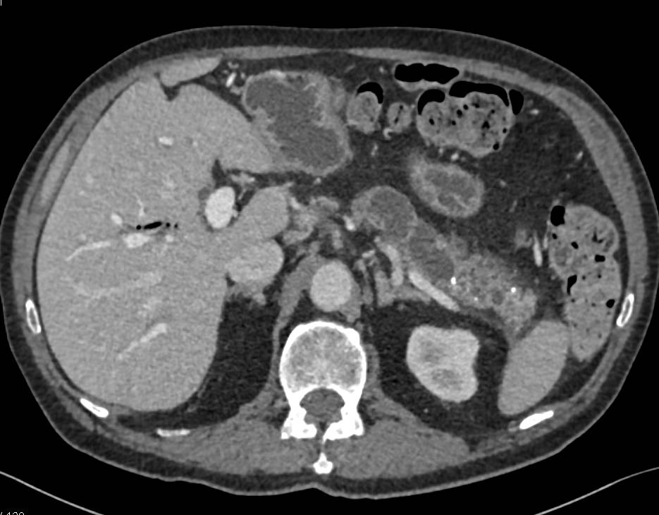 Central Intraductal Papillary Mucinous Neoplasm (IPMN) with High Grade Dysplasia - CTisus CT Scan