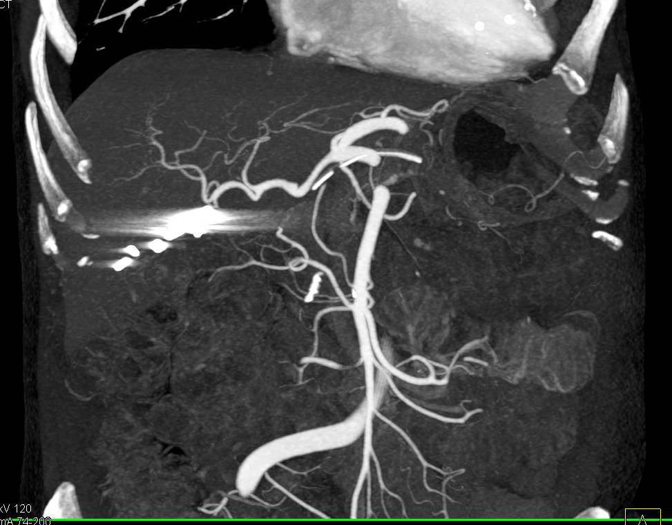 Stent in Dilated Pancreatic Duct S/P Whipple Procedure - CTisus CT Scan