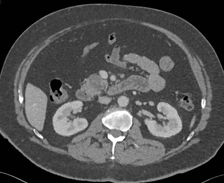 Adenocarcinoma of the Head of the Pancreas - CTisus CT Scan