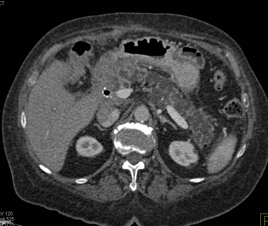 Pancreatic Cancer Arises in a Gland with Numerous Intraductal Papillary Mucinous Neoplasms (IPMNs) - CTisus CT Scan