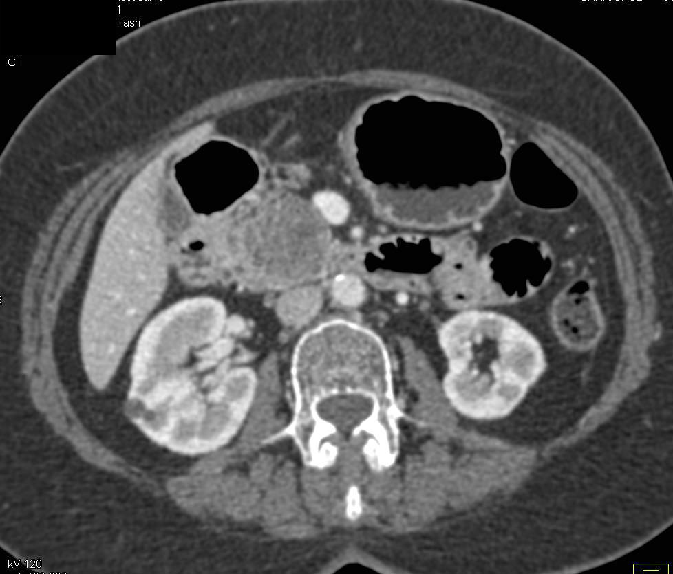 Serous Cystadenoma in Head of Pancreas - CTisus CT Scan