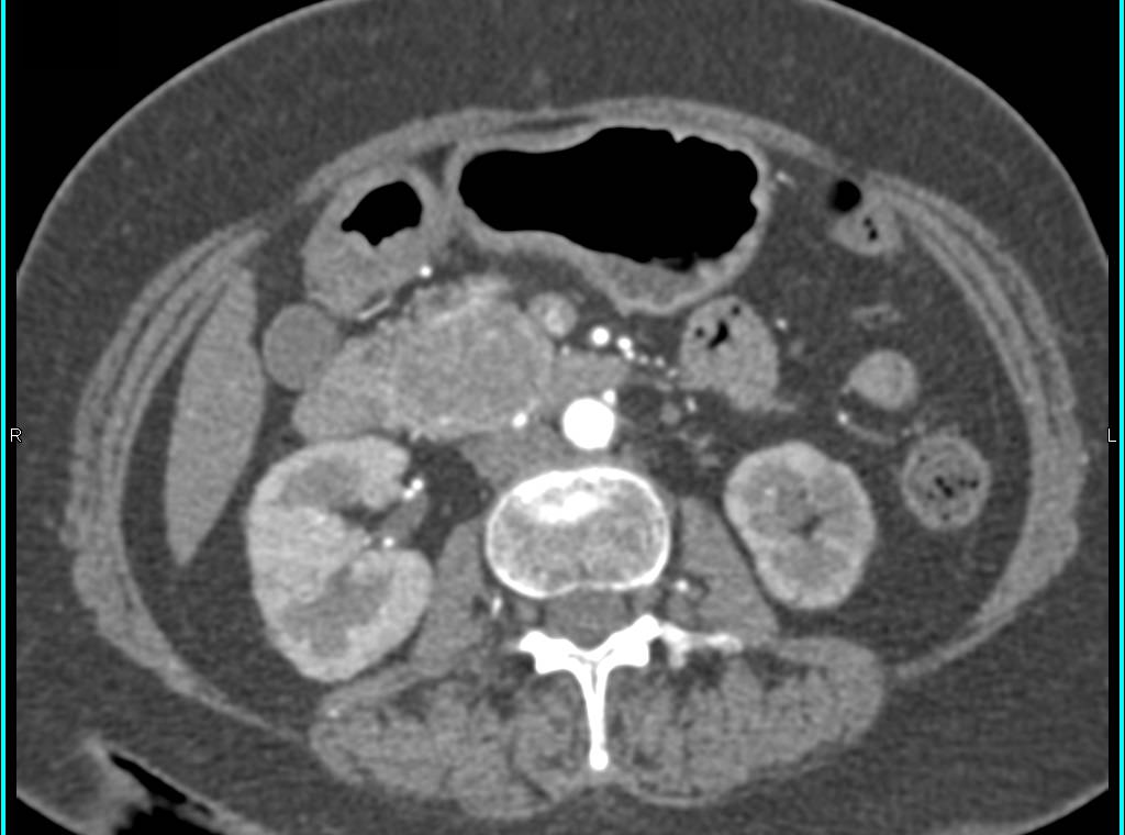 Serous Cystadenoma in Head of Pancreas (additional renderings) - CTisus CT Scan