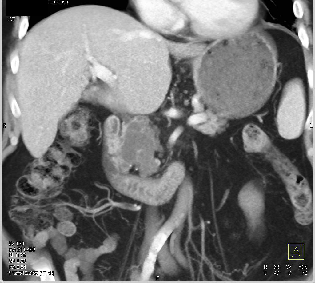 Intraductal Papillary Mucinous Neoplasm (IPMN) Head of Pancreas - CTisus CT Scan