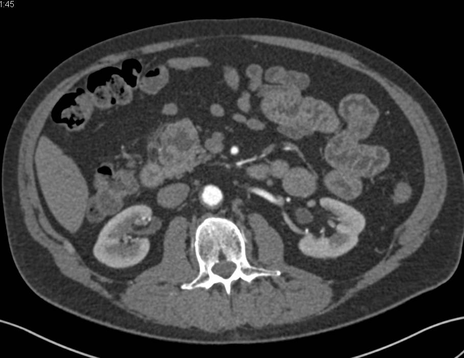 Cystic Neuroendocrine Tumor in the Head of the Pancreas - CTisus CT Scan