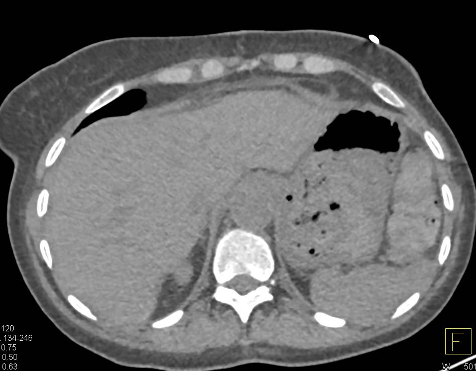 Post Whipple Procedure with Drains in Place and Fluid Present - CTisus CT Scan