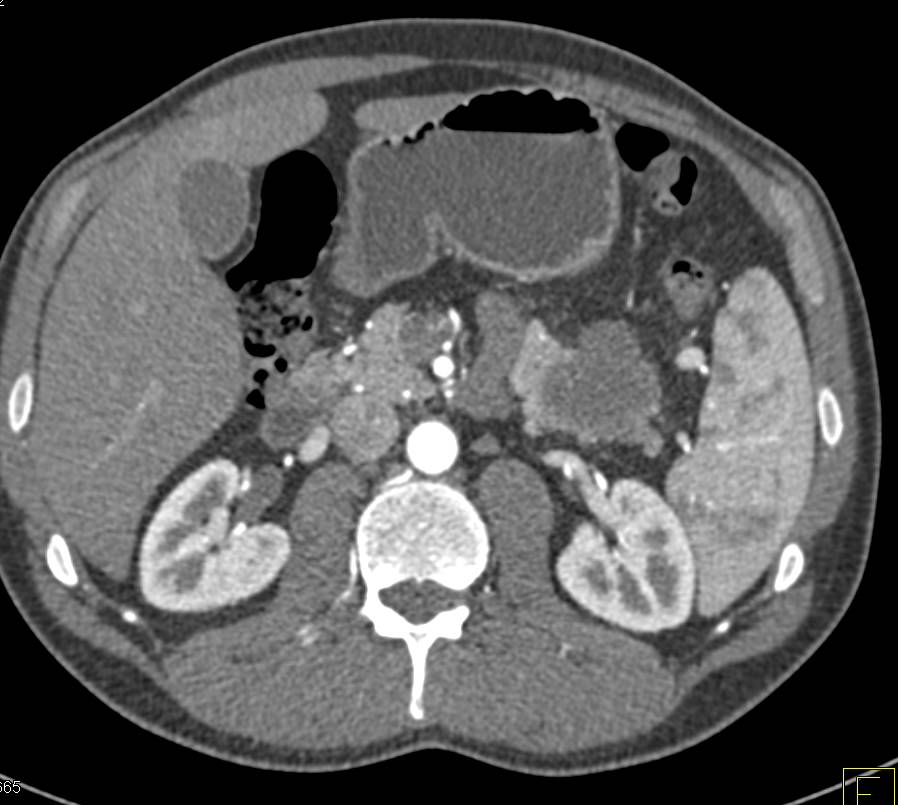 Carcinoma Tail of the Pancreas - CTisus CT Scan