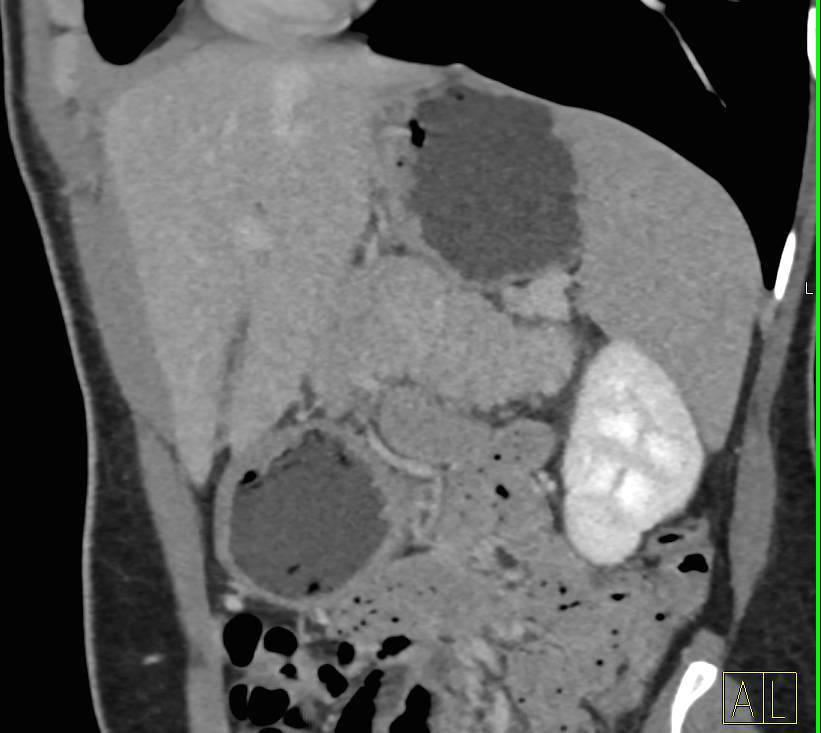 Carcinoma Tail of the Pancreas - CTisus CT Scan