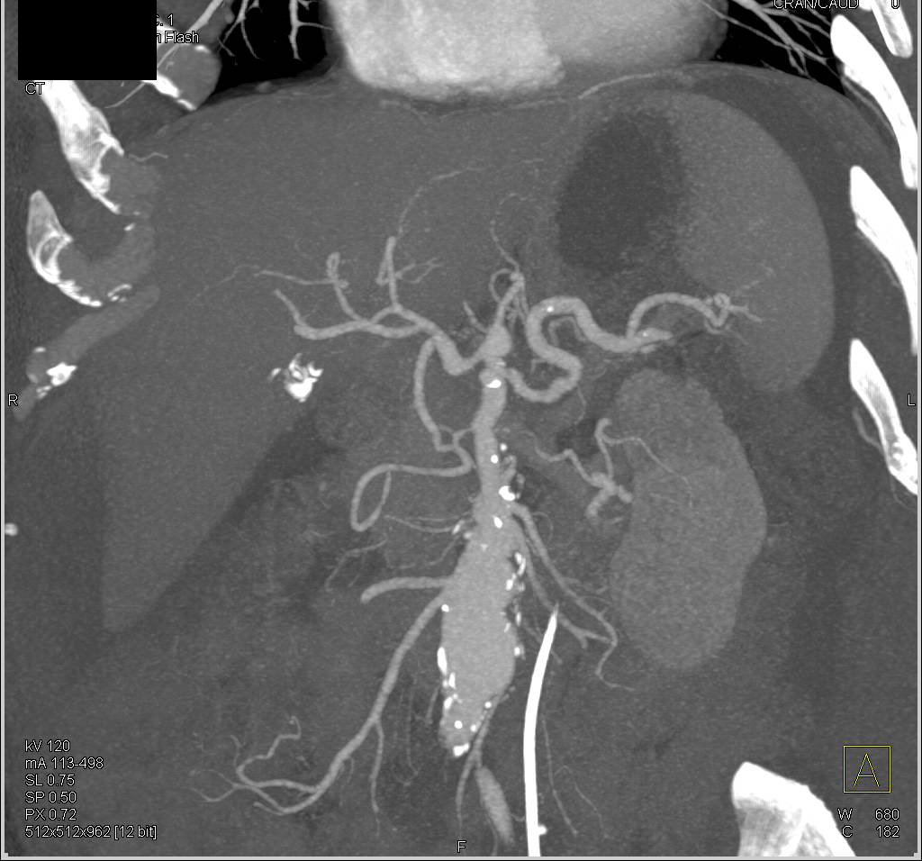 Carcinomatosis due to Pancreatic Cancer - CTisus CT Scan