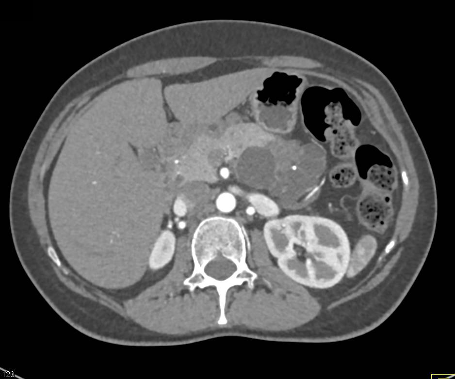 Serous Cystadenoma with Central Calcification - CTisus CT Scan