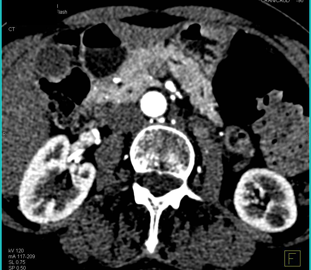 Subtle Neuroendocrine Tumor Body of the Pancreas - CTisus CT Scan