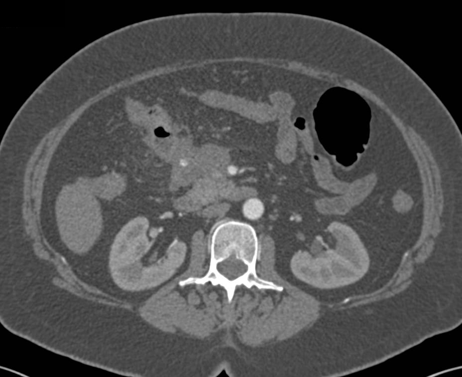 Carcinoid Tumor with Liver Metastases Simulates a Pancreatic Mass - CTisus CT Scan