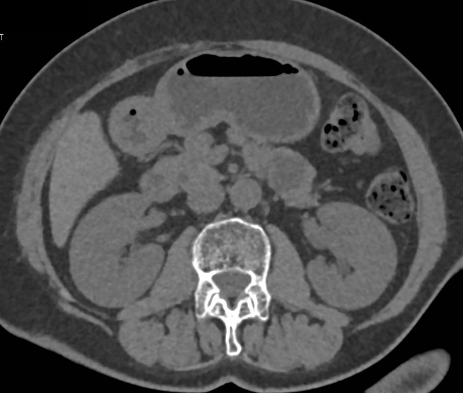 MCN (Mucinous Cystic Neoplasm) Pancreas - CTisus CT Scan