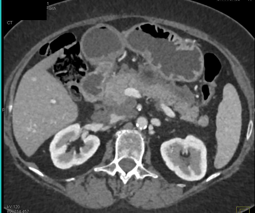 Acute Pancreatitis with Pseudocysts - CTisus CT Scan