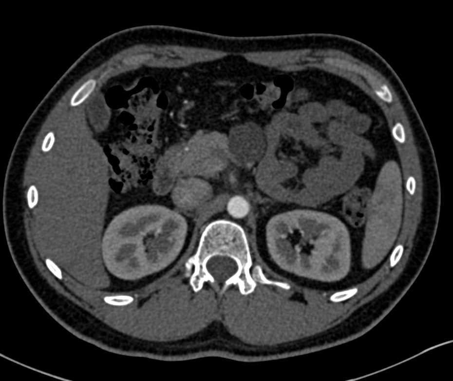 Lymphoepithelial Cyst of the Body of the Pancreas - CTisus CT Scan