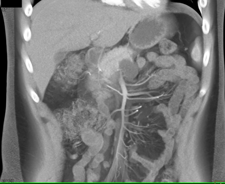 Lymphoepithelial Cyst of the Body of the Pancreas - CTisus CT Scan