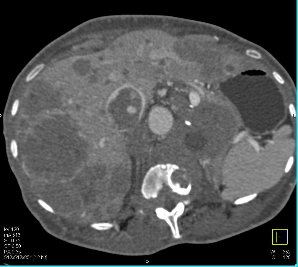 Pancreatic Cancer with Liver Metastases - CTisus CT Scan