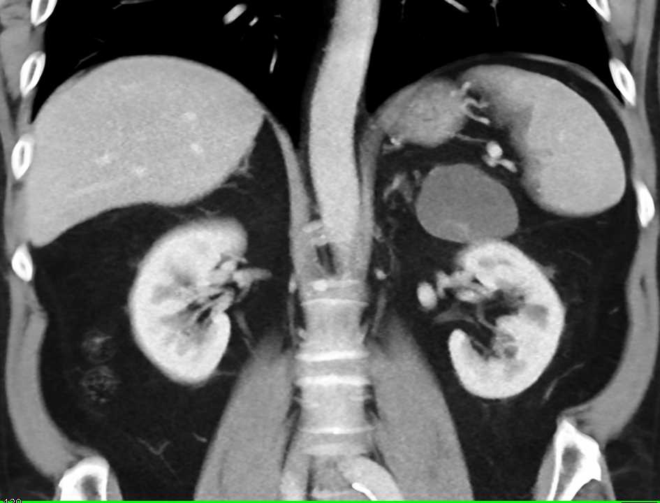 Lymphoepithelial Cyst of the Tail of the Pancreas - CTisus CT Scan